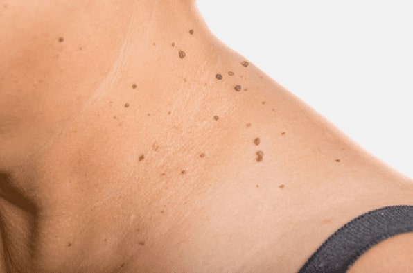 Are you looking for easy skin tag removal Torry - then contact Spire today!
