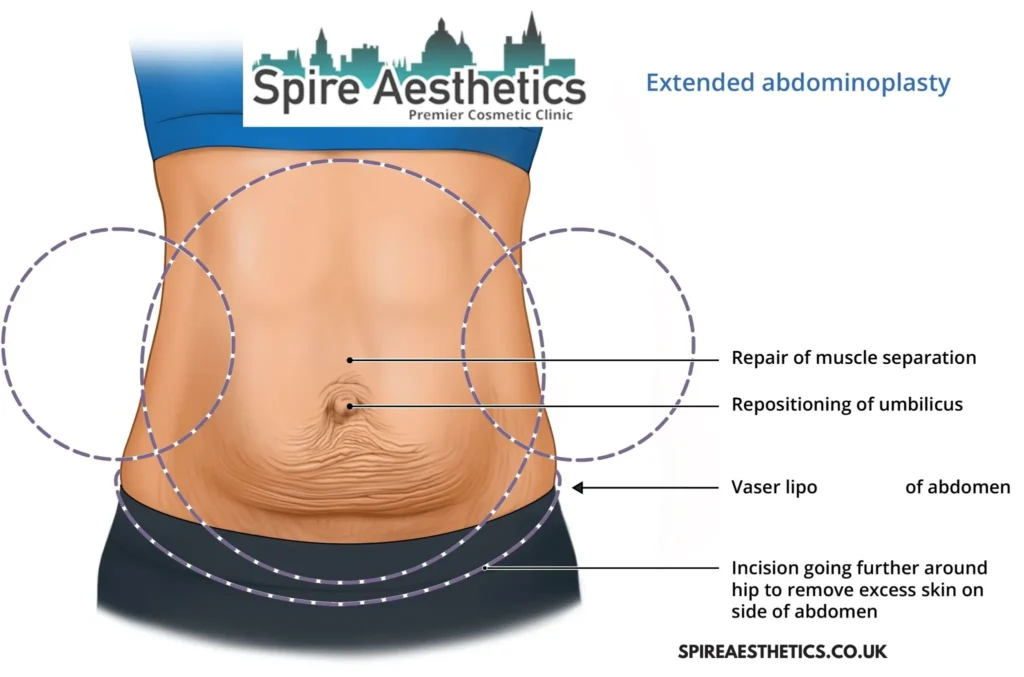 Understanding Loose Skin After Gastric Band Torry Surgery and HIFU Treatment