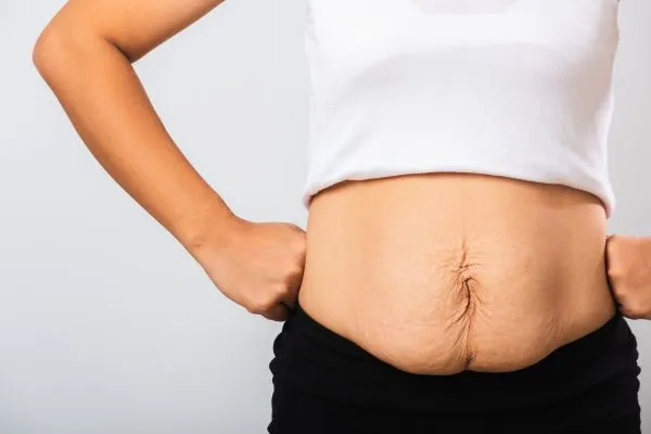 Image of a woman's stomach after weight loss with sagging skin following a gastric band Torry