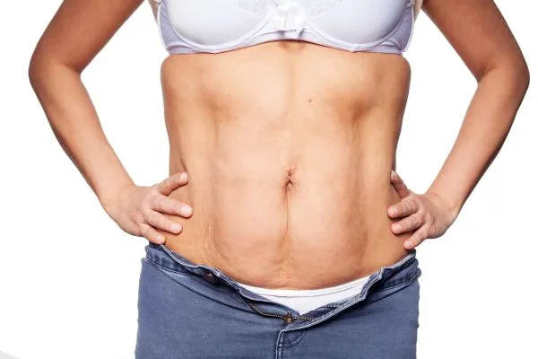 sagging skin on woman's stomach after weight loss injections Torry
