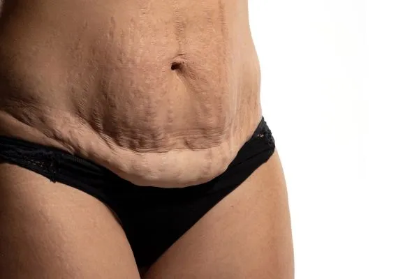 Image of womans stomach after weight loss injections Torry showing saggy skin